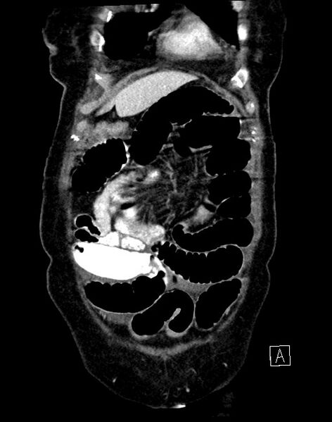 File:Broad ligament hernia (Radiopaedia 84802-100276 B 62).jpg
