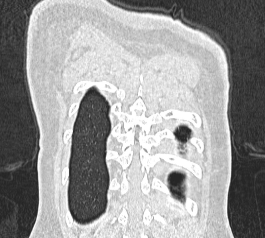 Bronchial atresia (Radiopaedia 50007-55297 Coronal lung window 111).jpg