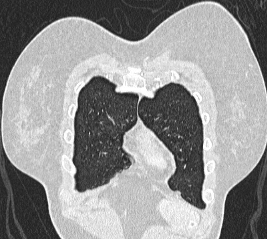 Bronchial atresia (Radiopaedia 50007-55297 Coronal lung window 6).jpg