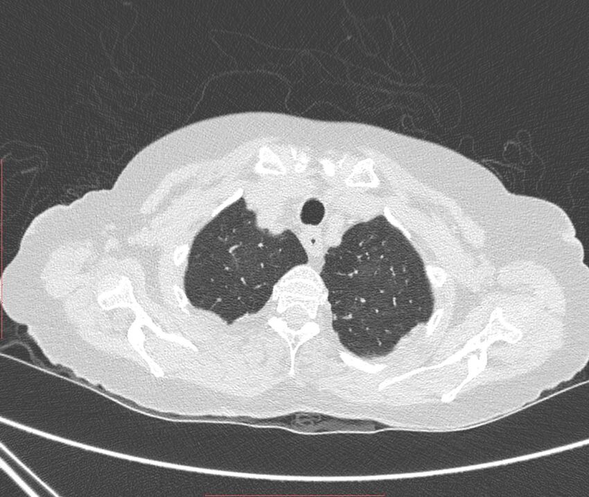 Bronchiectasis (Radiopaedia 72693-83293 Axial lung window 12).jpg