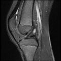 Bucket handle tear - lateral meniscus (Radiopaedia 72124-82634 Sagittal PD fat sat 8).jpg