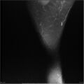 Bucket handle tear - lateral meniscus (Radiopaedia 7246-8187 Sagittal T2 fat sat 1).jpg