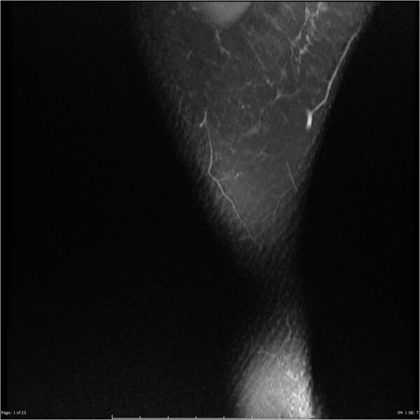 File:Bucket handle tear - lateral meniscus (Radiopaedia 7246-8187 Sagittal T2 fat sat 1).jpg
