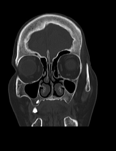 File:Burnt-out meningioma (Radiopaedia 51557-57337 Coronal bone window 8).jpg