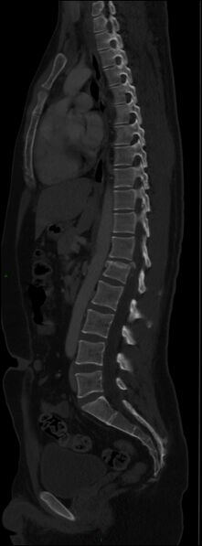 File:Burst fracture (Radiopaedia 83168-97542 Sagittal bone window 70).jpg