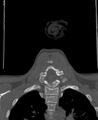 Butterfly vertebra (Radiopaedia 77903-90209 Coronal bone window 55).jpg