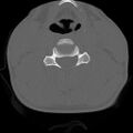 C5 facet fracture (Radiopaedia 58374-65499 Axial bone window 50).jpg