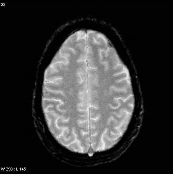 File:CMV ventriculitis and encephalitis (Radiopaedia 5416-7166 Axial Gradient Echo 6).jpg