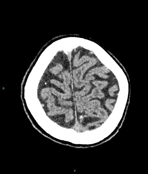 File:Calcified cerebral emboli from left ventricular thrombus (Radiopaedia 84420-99758 Axial non-contrast 16).jpg