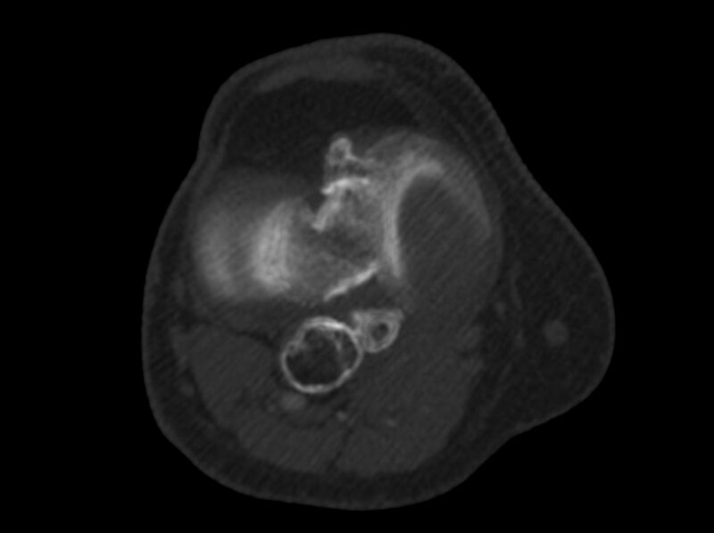File:Calcified hematoma - popliteal fossa (Radiopaedia 63938-72763 C 28).jpg