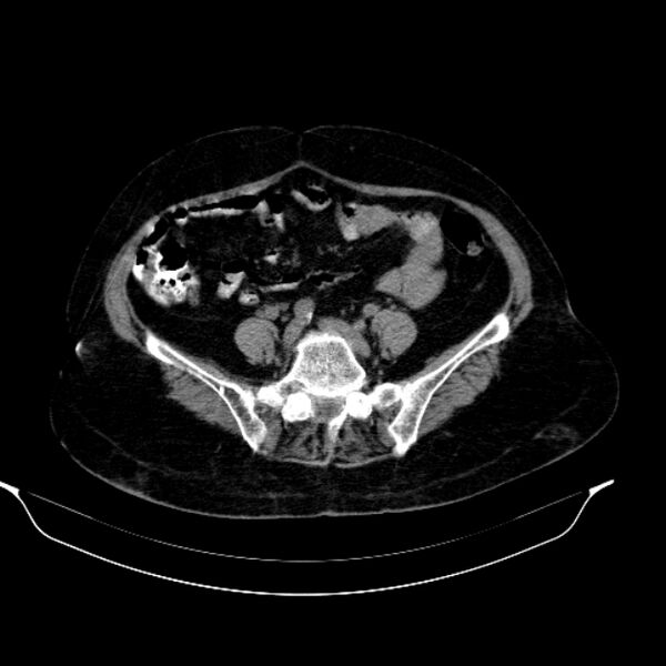 File:Calcified hydatid cyst (Radiopaedia 62000-70085 Axial non-contrast 76).jpg