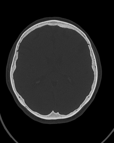 File:Calcified meningioma (Radiopaedia 74361-85243 Axial bone window 23).jpg