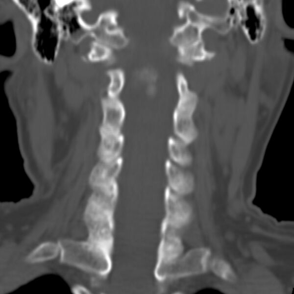 File:Calcified meningioma - cervical canal (Radiopaedia 70136-80171 Coronal bone window 13).jpg