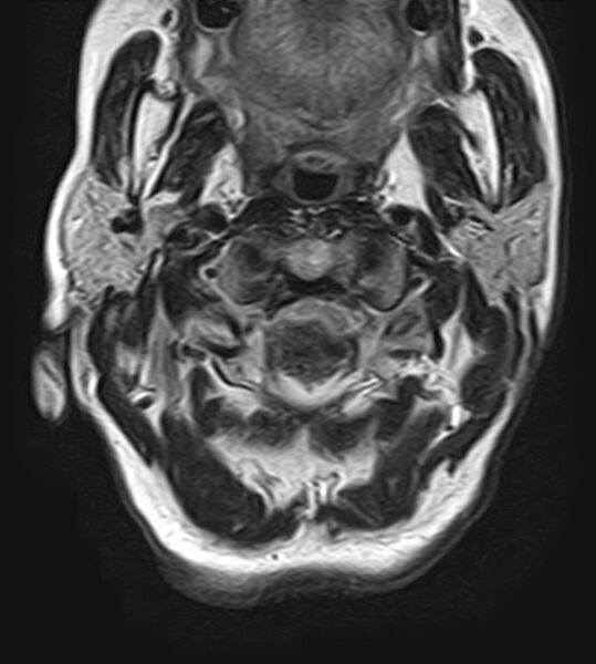 File:Calcified meningioma - cervical canal (Radiopaedia 70136-82468 Axial T2 5).jpg