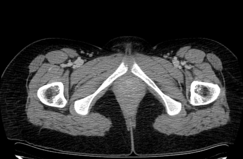 Cannonball metastases - uterine choriocarcinoma (Radiopaedia 70137-80174 A 73).jpg