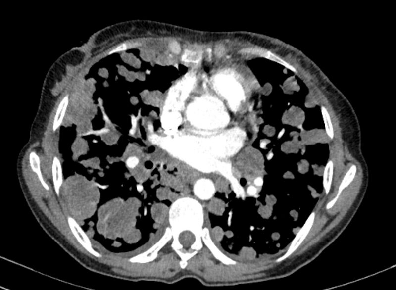 File:Cannonball metastases from breast cancer (Radiopaedia 91024-108569 A 67).jpg