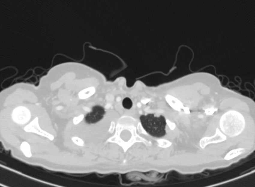 Cannonball metastases from breast cancer (Radiopaedia 91024-108569 Axial lung window 4).jpg
