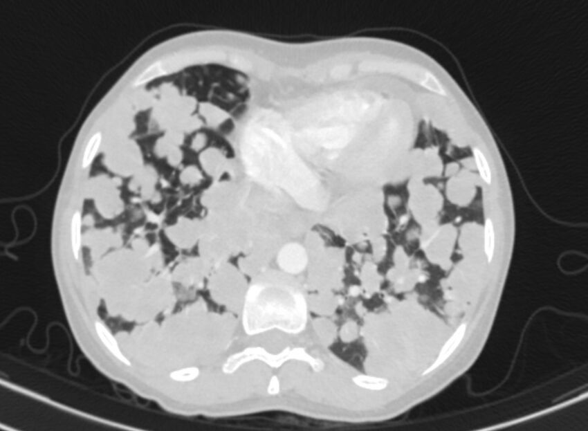 Cannonball metastases from breast cancer (Radiopaedia 91024-108569 Axial lung window 78).jpg
