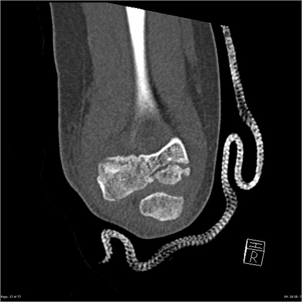 File:Capitellum fracture (Radiopaedia 23352-23426 Coronal bone window 27).jpg