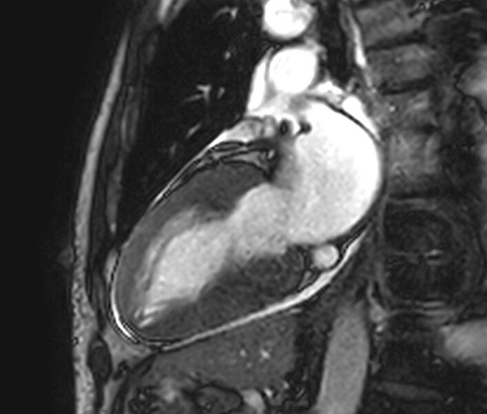 File:Cardiac amyloidosis (Radiopaedia 39736-42124 B 19).jpg