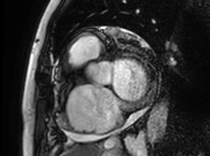 Cardiac amyloidosis (Radiopaedia 61600-69579 Short axis bSSFP 323).jpg