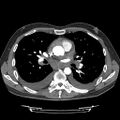 Cardiac tamponade (Radiopaedia 78607-91368 Axial C+ CTPA 42).jpg