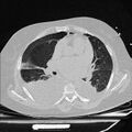 Cardiogenic pulmonary edema (Radiopaedia 29213-29609 Axial lung window 48).jpg