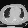 Cardiogenic pulmonary edema (Radiopaedia 29213-29609 Axial lung window 57).jpg