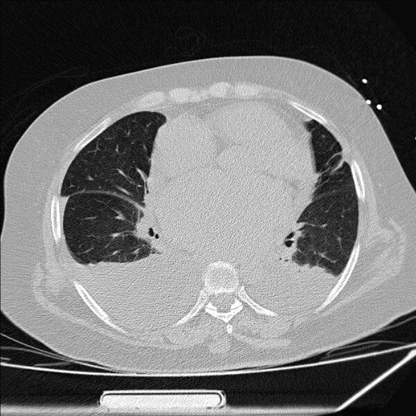 File:Cardiogenic pulmonary edema (Radiopaedia 29213-29609 Axial lung window 57).jpg