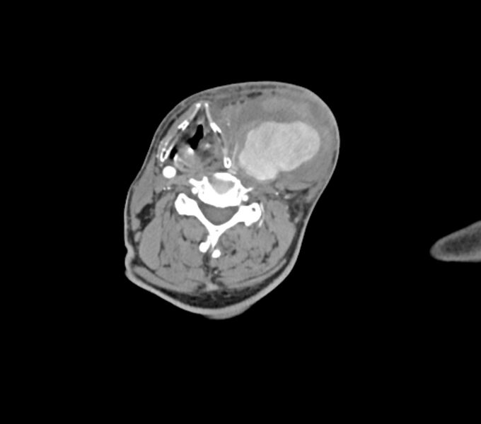 File:Carotid artery pseudoaneurysm (Radiopaedia 84030-99259 C 48).jpg