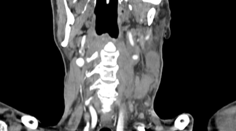 File:Carotid artery pseudoaneurysm (Radiopaedia 84030-99259 D 50).jpg