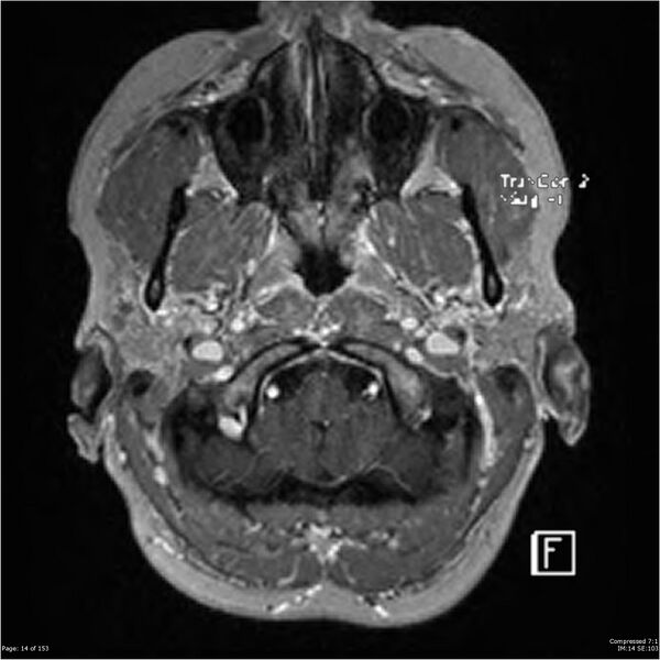 File:Cavernous malformation (cavernous angioma or cavernoma) (Radiopaedia 36675-38237 Axial T1 C+ 7).jpg