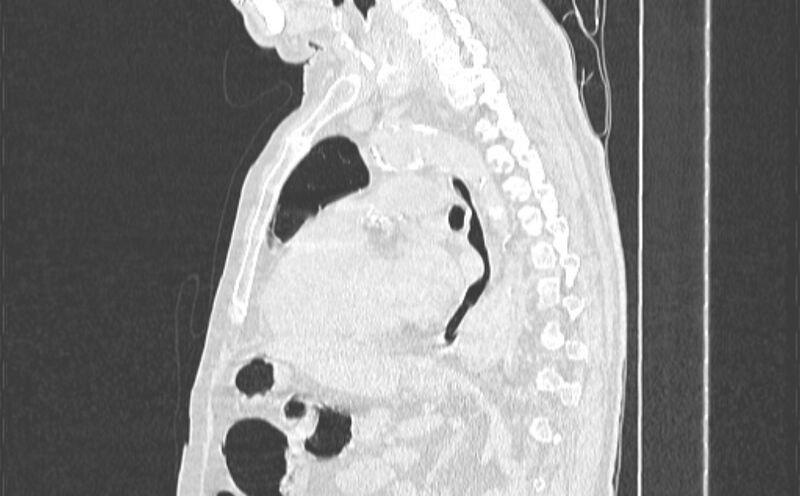 File:Cavitating bronchogenic carcinoma (Radiopaedia 44489-48162 Sagittal lung window 36).jpg