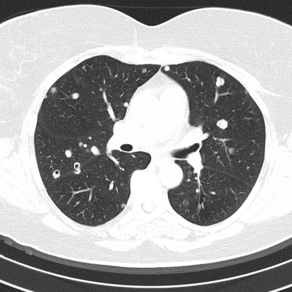 File:Cavitating pulmonary metastases (Radiopaedia 17796-17555 Axial lung window 8).jpg