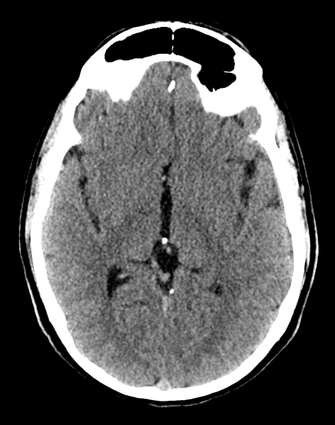 File:Cerebellar infarct due to vertebral artery dissection with posterior fossa decompression (Radiopaedia 82779-97033 Axial non-contrast 18).png