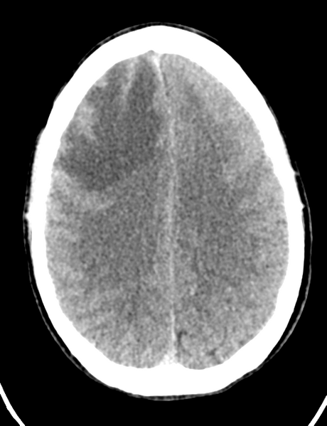 File:Cerebral abscess (Radiopaedia 60342-68008 Axial non-contrast 36).png