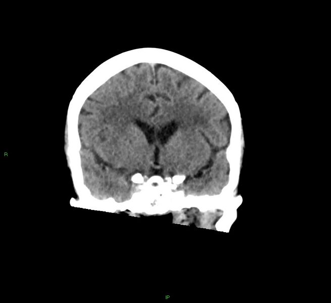 File:Cerebral amyloid angiopathy-associated lobar intracerebral hemorrhage (Radiopaedia 58378-65516 Coronal non-contrast 40).jpg