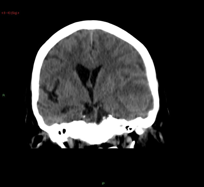 Cerebral amyloid angiopathy-associated lobar intracerebral hemorrhage (Radiopaedia 58378-65518 Coronal non-contrast 43).jpg