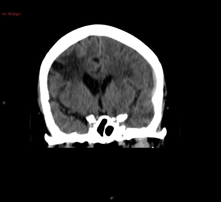 Cerebral amyloid angiopathy-associated lobar intracerebral hemorrhage (Radiopaedia 58378-65518 Coronal non-contrast 49).jpg
