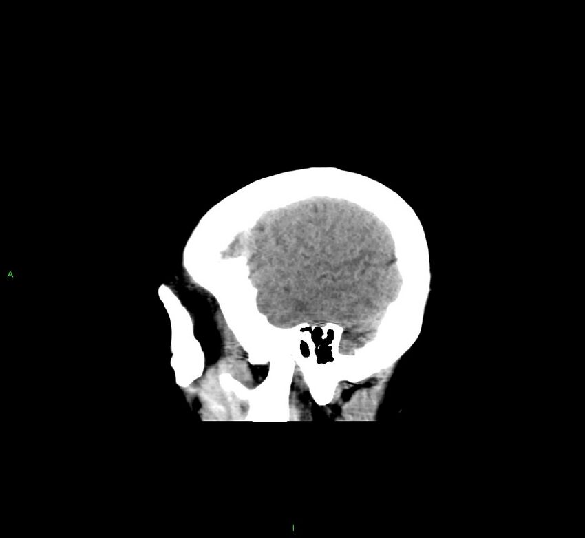 Cerebral amyloid angiopathy-associated lobar intracerebral hemorrhage (Radiopaedia 58529-65681 B 42).jpg