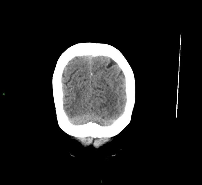 File:Cerebral amyloid angiopathy-associated lobar intracerebral hemorrhage (Radiopaedia 58529-65681 Coronal non-contrast 11).jpg