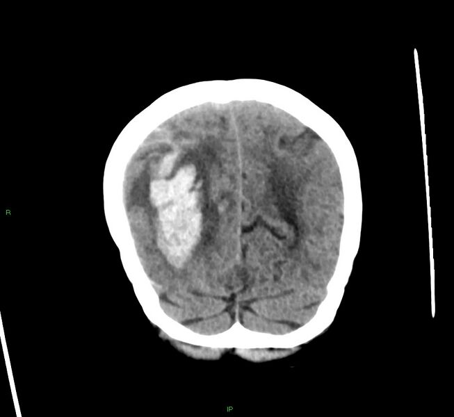 File:Cerebral amyloid angiopathy-associated lobar intracerebral hemorrhage (Radiopaedia 58563-65727 Coronal non-contrast 17).jpg