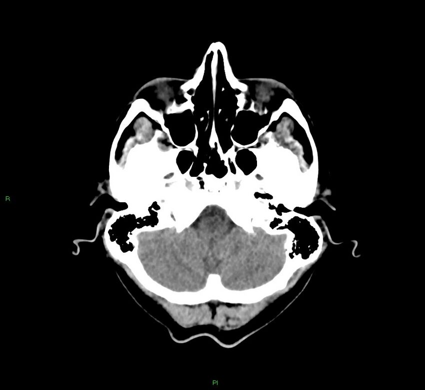 Cerebral amyloid angiopathy-associated lobar intracerebral hemorrhage (Radiopaedia 58756-65977 Axial non-contrast 44).jpg