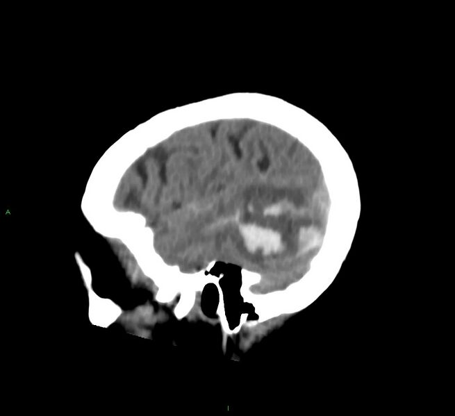 File:Cerebral amyloid angiopathy-associated lobar intracerebral hemorrhage (Radiopaedia 58757-65978 C 45).jpg