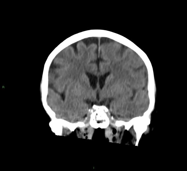 File:Cerebral amyloid angiopathy-associated lobar intracerebral hemorrhage (Radiopaedia 58757-65978 Coronal non-contrast 40).jpg