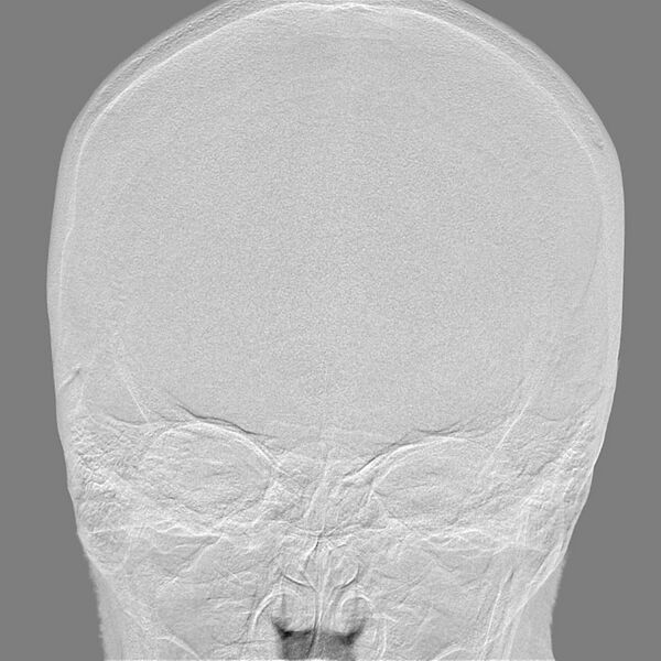 File:Cerebral aneurysm with rupture (Radiopaedia 29933-30458 LT CCA IC 1).jpg