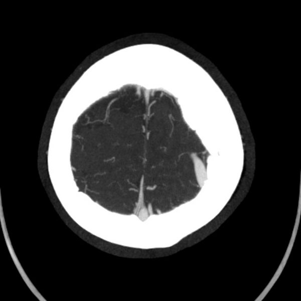 File:Cerebral arteriovenous malformation (Radiopaedia 43729-47189 B 44).jpg