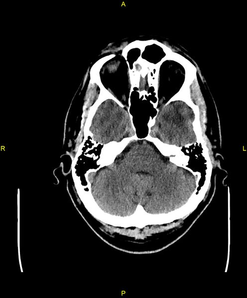File:Cerebral autosomal dominant arteriopathy with subcortical infarcts and leukoencephalopathy (CADASIL) (Radiopaedia 86108-102051 Axial non-contrast 24).jpg