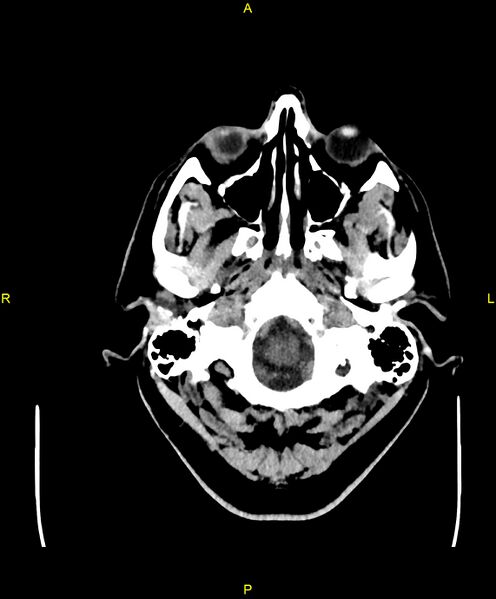 File:Cerebral autosomal dominant arteriopathy with subcortical infarcts and leukoencephalopathy (CADASIL) (Radiopaedia 86108-102051 Axial non-contrast 7).jpg