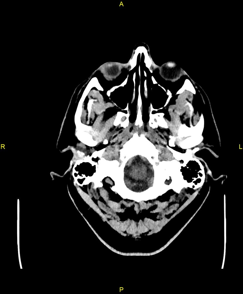 Cerebral autosomal dominant arteriopathy with subcortical infarcts and leukoencephalopathy (CADASIL) (Radiopaedia 86108-102051 Axial non-contrast 7).jpg
